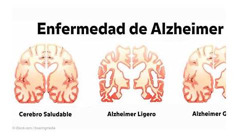 Pruebas de neuroimagen predecirían el alzhéimer 15 años antes de que