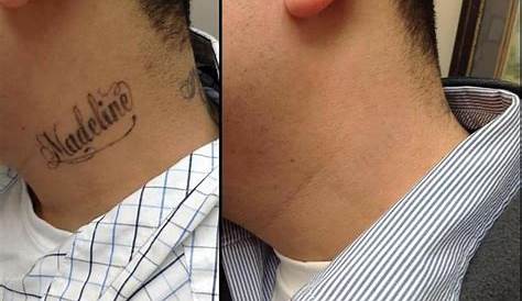 Laser tattoo removal at WA Ink by @mjdriverlasertattooremoval and
