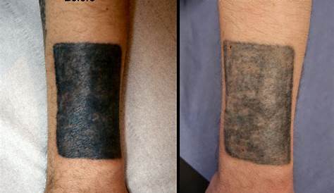 Remove Tattoo Temporary | remove excess tattoo ink off skin