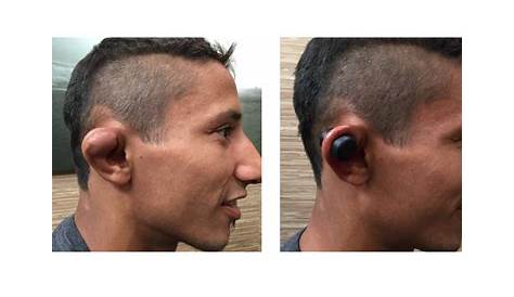 What is CAULIFLOWER EAR? How Can You prevent it? How Do you Treat it