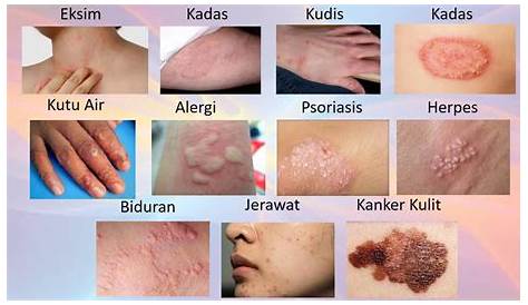 Gambar penyakit kulit