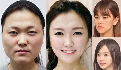 Korean Beauty Standards Plastic Surgery Types
