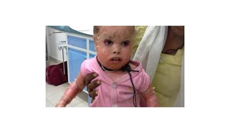 Lamellar Ichthyosis Baby Suffers Rare Severe Condition