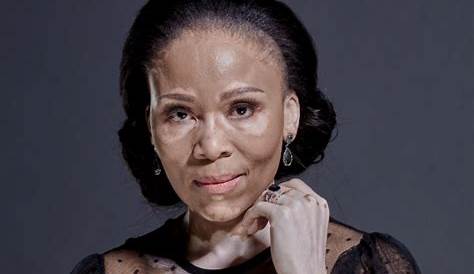 Unveiling The Truths Of Leleti Khumalo's Skin Condition: A Journey Of Discovery