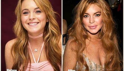 Lindsay Lohan's Plastic Surgery Makeover Exposed By Top Docs