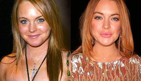 Lindsay Lohan's Surgeries: Uncovering The Truths And Transformations