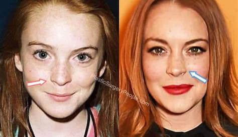 Unveiling The Evolution Of Lindsey Lohan's Nose: Insights And Discoveries