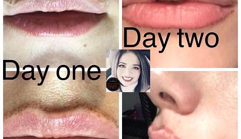 Lip Flip Before & After Gallery Dr. Cory