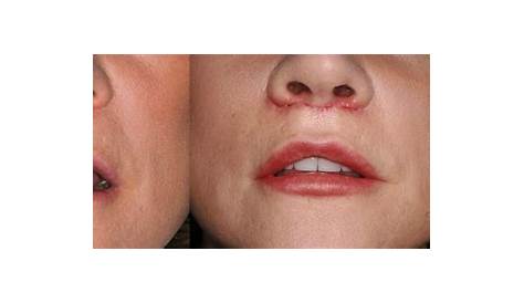 Lip Lift photos Aesthetic Surgery Center