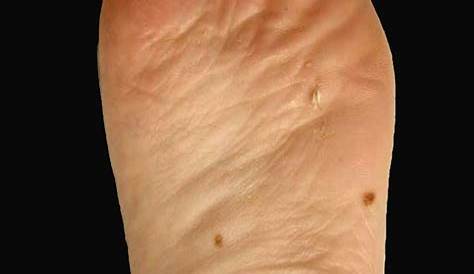 Lunares en pies y manos | Doctora Lorea Bagazgoitia Dermatología