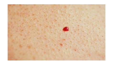 Lunares rojos en la piel: ¿A qué se deben? — Mejor con Salud