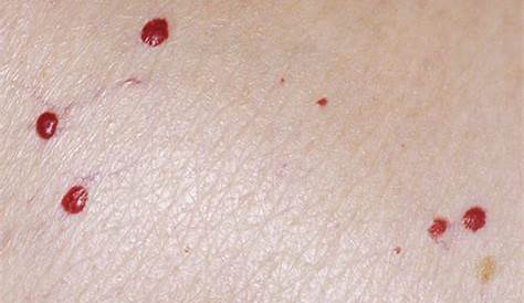 ¿Qué significan los puntos rojos que salen en la piel? | Bioguia