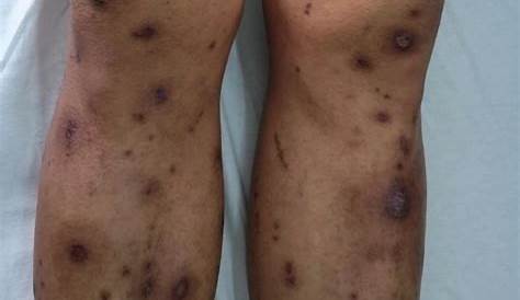 Manchas marrones en piernas, pies o brazos. – dermatologo.net