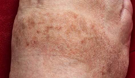 Manchas marrones en pierna y tobillo – dermatologo.net