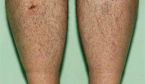 Papular Mycosis Fungoides on the Legs: A Case Report | Actas Dermo