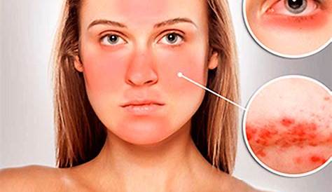 Manchas rojas en la piel: 20 posible causas, síntomas y tratamiento