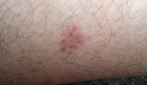 manchas rojas en la piel. pierna masculina con muchas manchas rojas y
