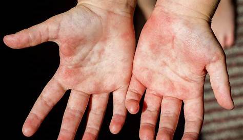 Manchas rojas sobre la piel de las manos | Muy Fitness