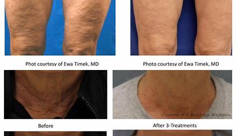 Microneedling Legs Before And After