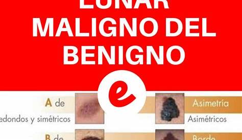 Cómo hacer un efectivo control de los lunares - Salud - Profesional FM