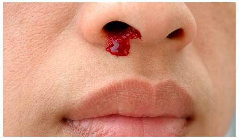 Home Remedies: 4 steps to stop a nosebleed - Mayo Clinic News Network