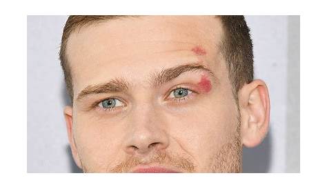 ‘911’ Actor Oliver Stark on His Eye Birthmark It’s Not Herpes! 91