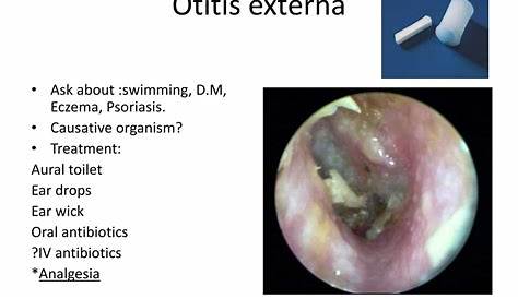 Otitis Externa Treatment Uptodate Acute An Update American Family Physician