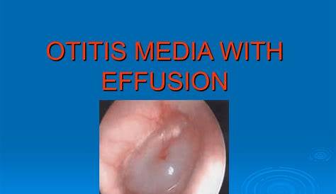 Otitis Media With Effusion In Adults Symptoms Or fection Of Middle Ear Stages Etiology