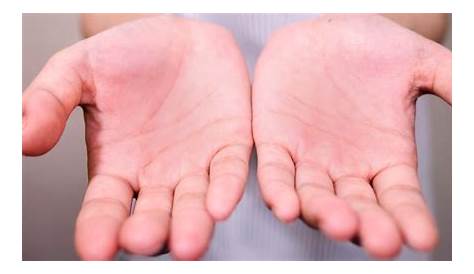 Por qué pueden inflamarse o ponerse coloradas las palmas de las manos