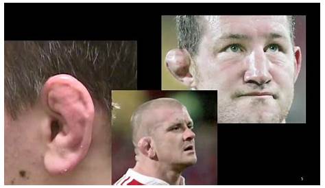 Why Do UFC Fighters Have Weird Ears? - How To Prevent It