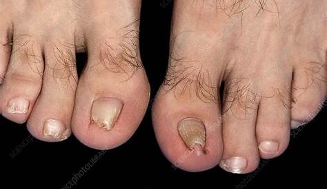 Pincer Nail Deformity Of The Right Great Toe. Preoperative