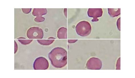 Cancer cells with red blood cells Stock Image C008