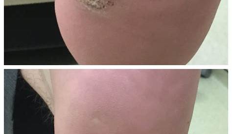 Plantar Wart Removal Before And After s Pictures B/A Photos Of s