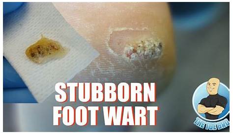 Plantar Wart Removal Photos Ses Of With Salicylic Acid Tutorial
