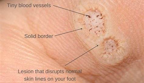 Plantar Wart Root Pull Out