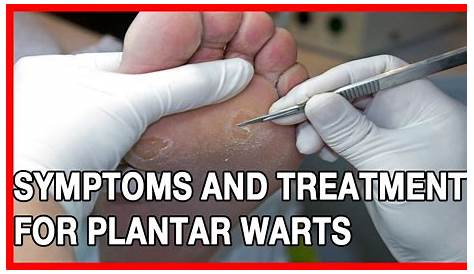 Plantar Wart Treatment 10ml Skin Tag Remover s Foot Corn