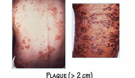 Plaque Disease Meaning In Tamil (PDF) Probiotics And Prebiotics Periodontal