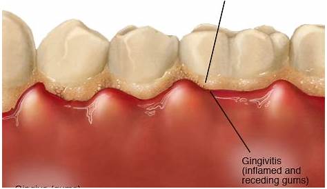Plaque and your teeth Waverley Oaks Dental