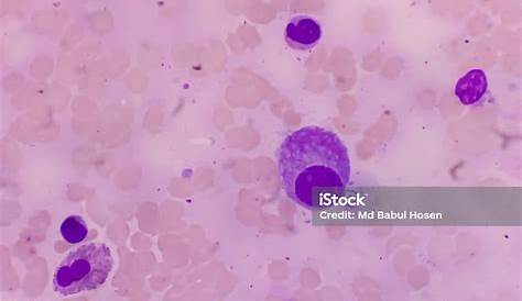 Plasmocytes Atypiques Expression Sanguine Des Lymphomes