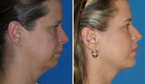 Before And After Plastic Surgery Of A Chin. Cosmetic Correction Small
