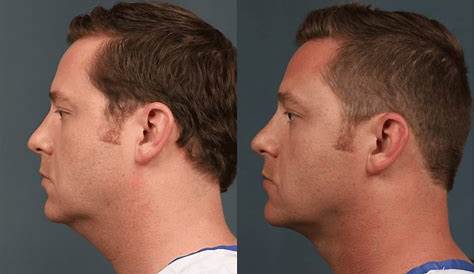 Before And After Plastic Surgery Of A Chin. Cosmetic Correction Small