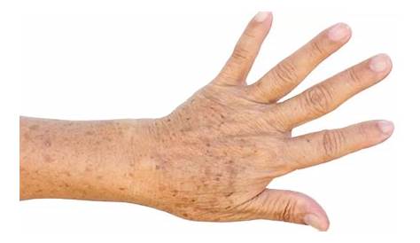 Como quitar las manchas de las manos con un tratamiento casero - YouTube