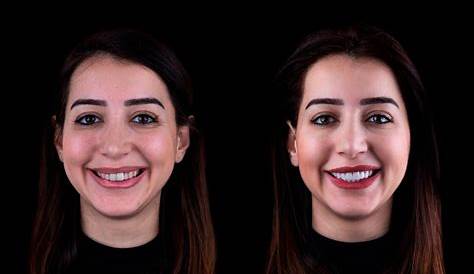 Diseño de sonrisas » La Clínica Facial