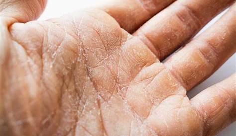 Remedios para manos con grietas, resecas o ásperas | Eczema symptoms