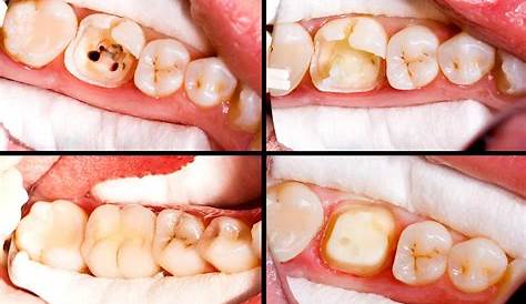 Root Canal Pictures Before And After