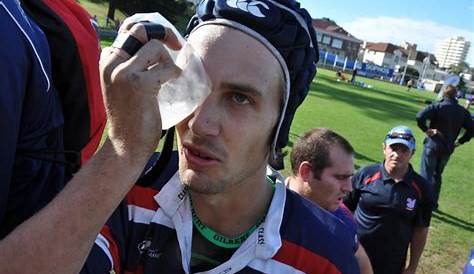Unveiling The Secrets Of Rugby Eye Injury: Discoveries And Insights