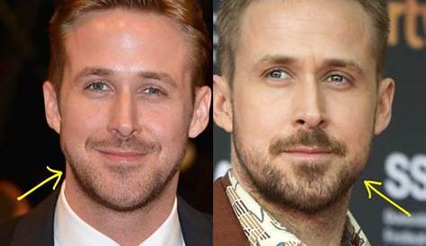 Unveil The Secrets Of Ryan Gosling Botox: Discoveries And Insights
