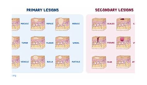 Skin Plaque Definition Primary++Lesions+nodule+cyst+bullae+macule+plaque