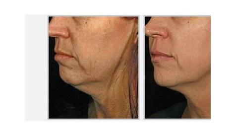 SkinTyte Laser Before and After Images Infinity Skin Clinic