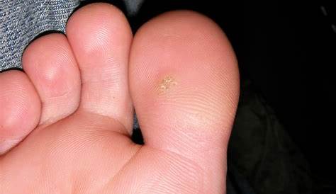 Small Plantar Wart On Toe What Are s And How Do We Treat Them? Prairie